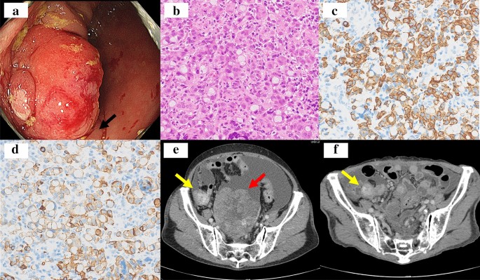 Primary ovarian signet ring cell carcinoma: A rare case report