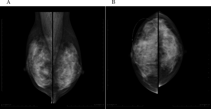 Incidental detection of pancreatic cancer by F-18-fluorodeoxyglucose positron emission tomography/computed tomography in a patient with hereditary breast and ovarian cancer syndrome