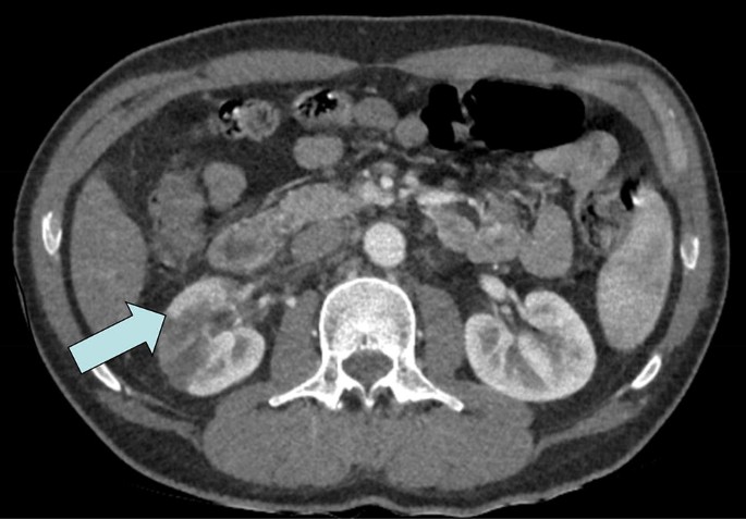 melanotan 2 upset stomach Melanotan II: a possible cause of renal infarction: review of the  literature and case report | CEN Case Reports