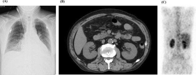 Unusual course of glyphosate-induced acute kidney injury: a case report of tubulointerstitial nephritis treated with steroids