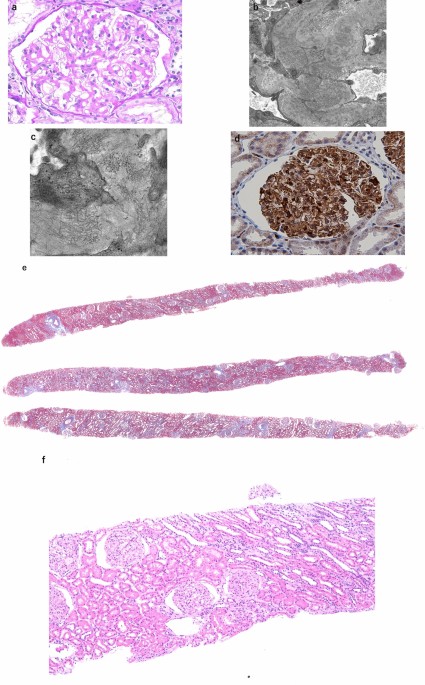 Diagnosis of fibrillary glomerulonephritis suggests possible atypical familial Mediterranean fever in a patient with ulcerative colitis