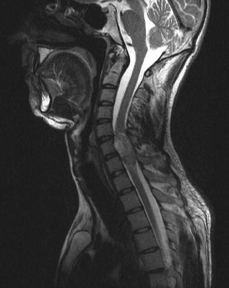Hereditary multiple exostoses with spinal cord compression.