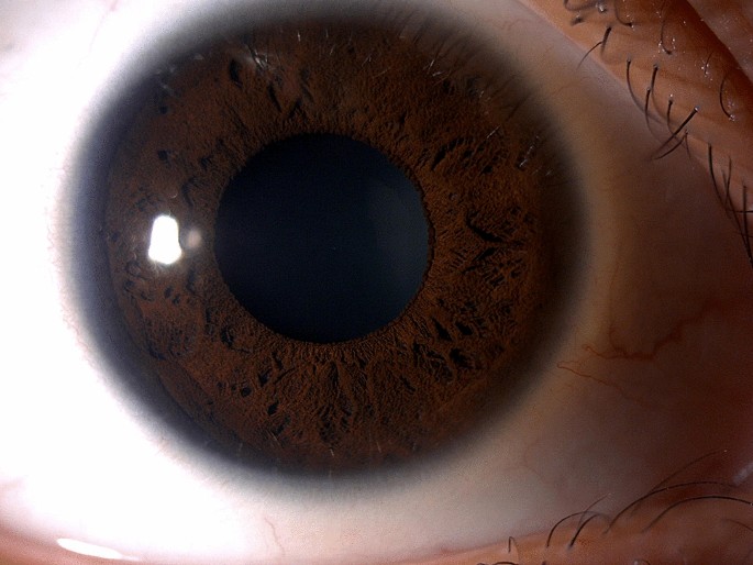 Dilated pupils in an anxious patient | Acta Neurologica Belgica