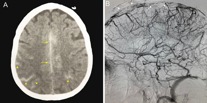 The subarachnoid hemorrhage (SAH) stages. The yellow arrows