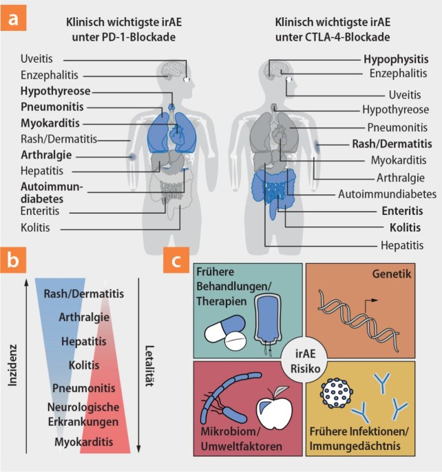 Nebenwirkungsmanagement bei Immuncheckpointinhibition | InFo Hämatologie + Onkologie