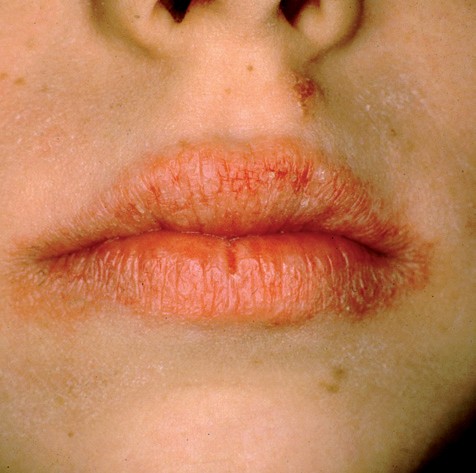 Cheilitis durch Sojasoe | MMW - Fortschritte der Medizin | Springer Nature  Link