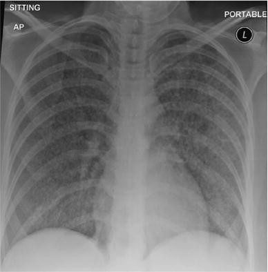 Miliary tuberculosis: sonographic pattern in chest ultrasound | Infection