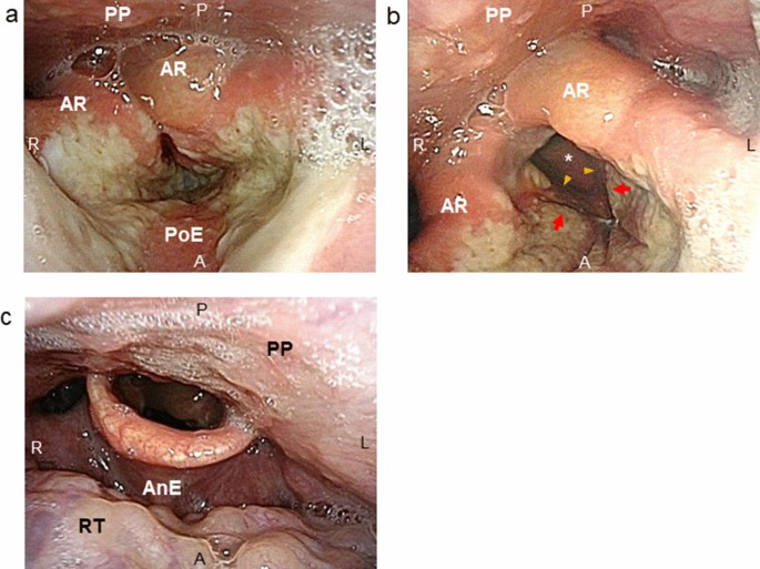 Endoscopic findings of laryngitis caused by SARS-CoV-2/Omicron variant  infection | Infection