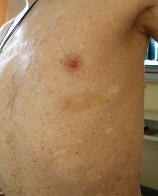 Neurofibrome und Café-au-lait-Flecken | hautnah dermatologie