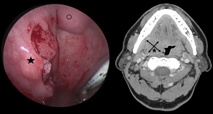 Immunotherapy in Head and Neck Cancer During Perioperative Period