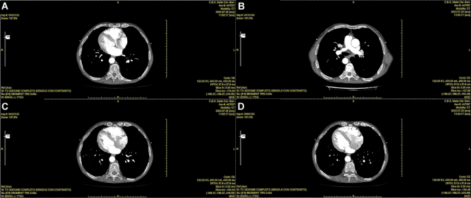 Niemann-Pick disease type B: HRCT assessment of pulmonary