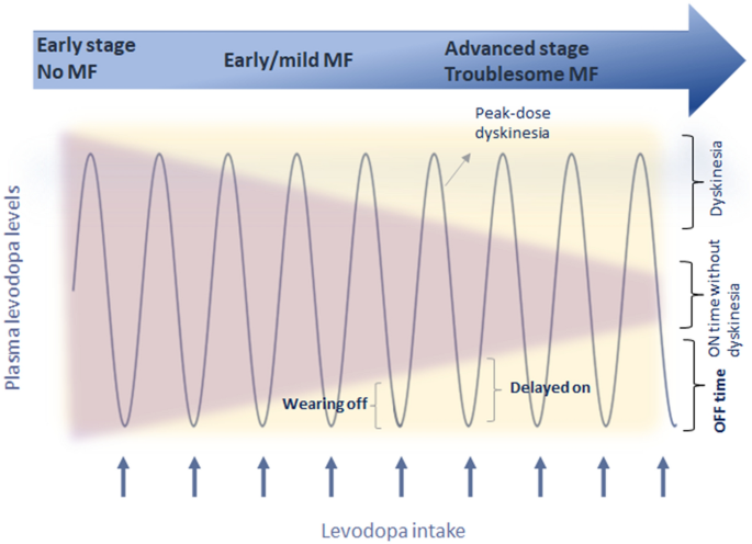 Off-time Treatment Options for Parkinson's Disease | Neurology and Therapy