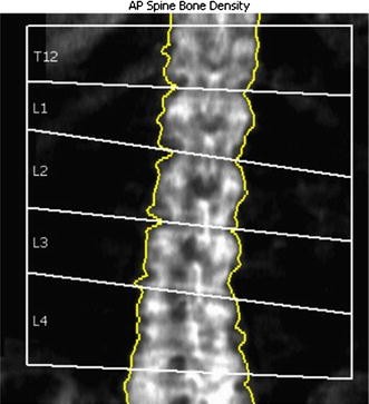 Bone Density Evaluation (DEXA) - Patient Services - Assured Imaging