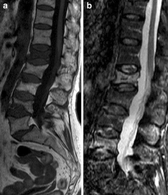 Compression Fractures of the Spine