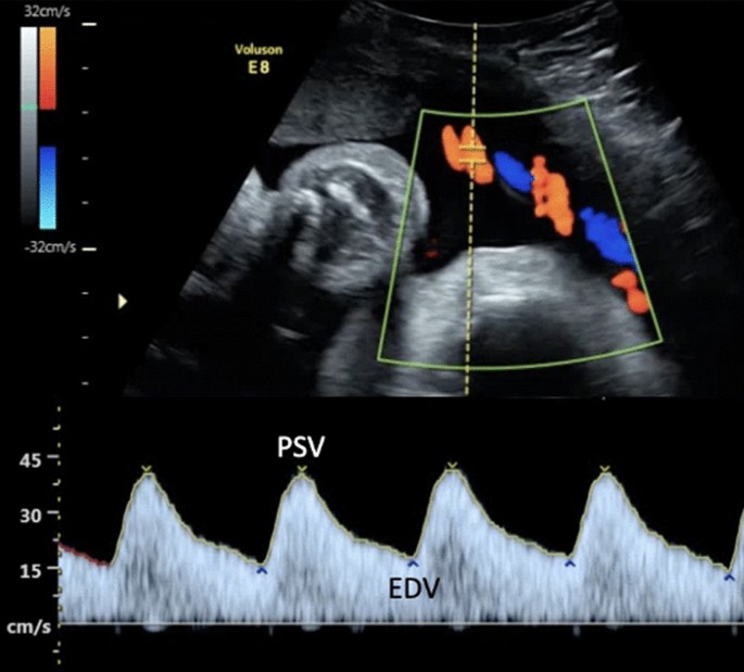 Clinical Applications for Doppler Ultrasonography in Obstetrics | Current  Radiology Reports