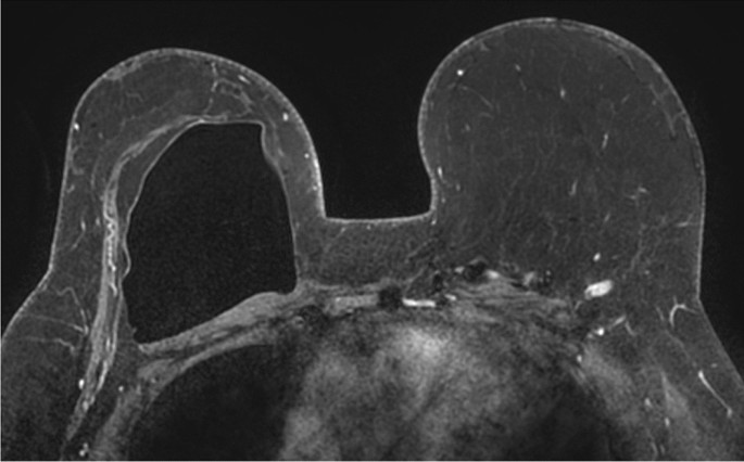 Increased asymmetry with larger breast size following the oncoplastic  parallelogram mastopexy lumpectomy for cancer - Chen - 2021 - The Breast  Journal - Wiley Online Library