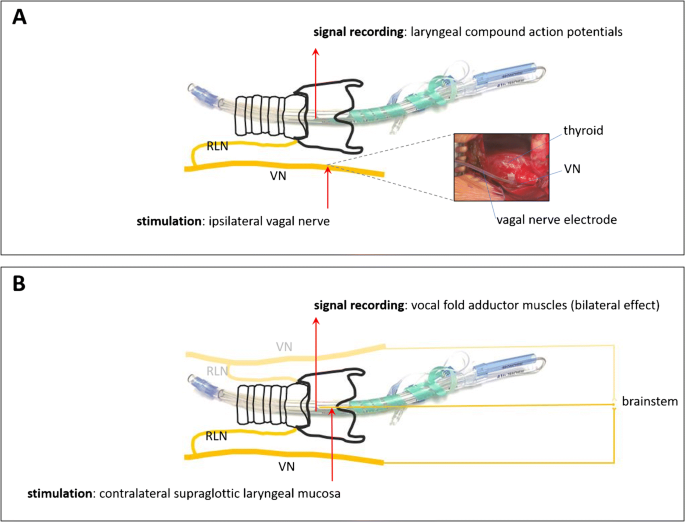 Continuous Intraoperative Recurrent Laryngeal Nerve Monitoring: Techniques,  Applications, and Controversies | Current Otorhinolaryngology Reports