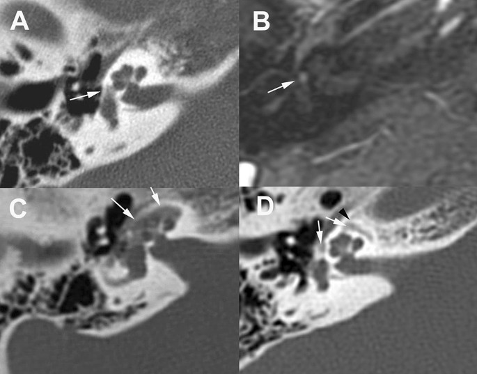 Otosclerosis, Otolaryngology⁠ — Head & Neck Surgery