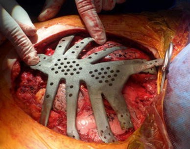 Figure 1 from Vascularized rib support for chest wall reconstruction using  Gore-Tex dual mesh after wide sternochondral resection.