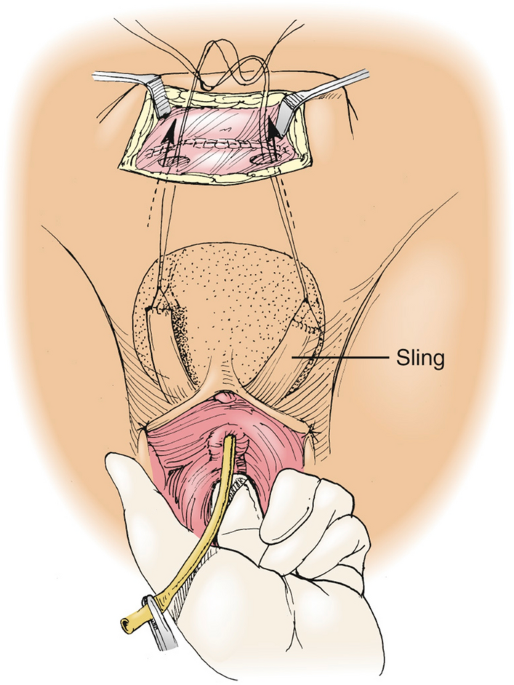 Overview of Surgical Management of Urinary Incontinence | Current Surgery  Reports