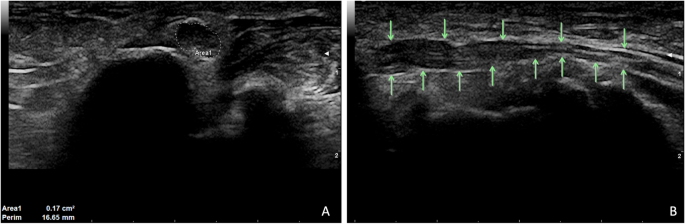 Frontiers  Ulnar Neuropathy at the Elbow: From Ultrasound Scanning to  Treatment