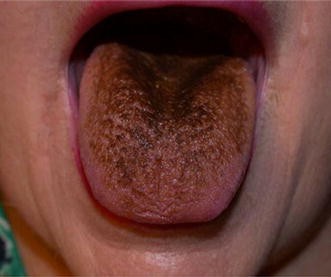smokeless tobacco withdrawal timeline Stop Smoking Timeline