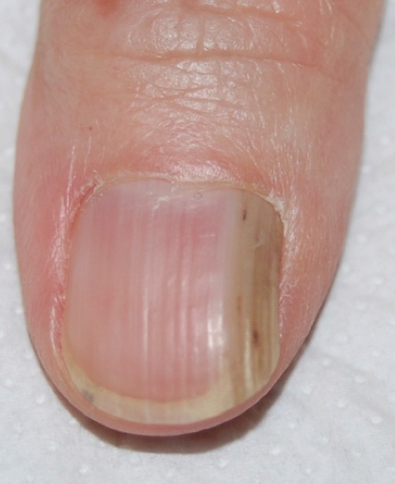 Figure 1 from Terry's Nails: A Sign of Systemic Disease | Semantic Scholar