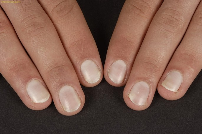 Leukonychia: What Can White Nails Tell Us? | American Journal of Clinical  Dermatology