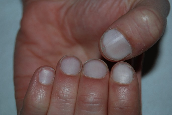 Terry's nails causes, differential diagnosis & treatment
