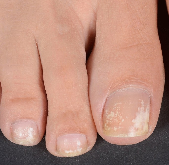 Leukonychia: What Can White Nails Tell Us? | American Journal of Clinical  Dermatology