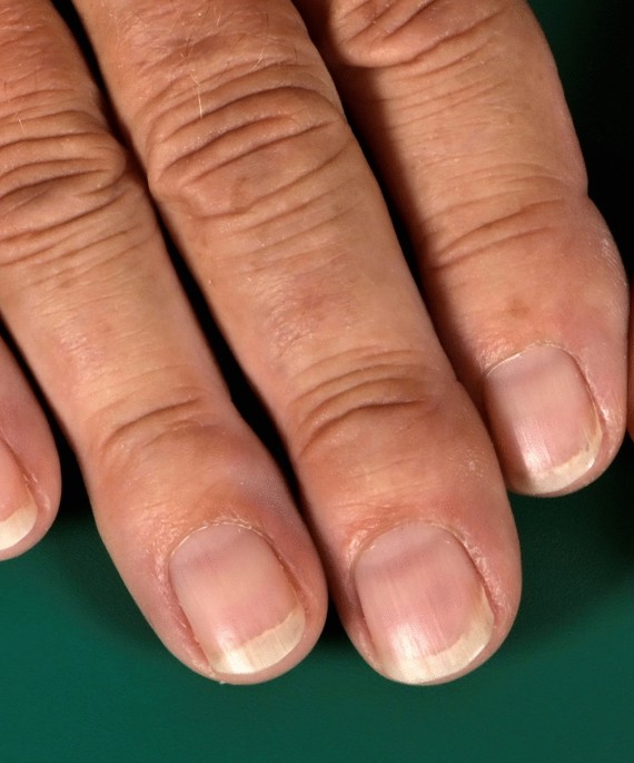 What is the significance of Terry's or Lindsay's nails in my hospitalized  patient? – Pearls4Peers