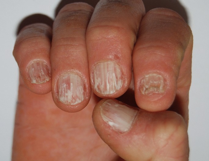 Cureus | Nail Whispers Revealing Dermatological and Systemic Secrets: An  Analysis of Nail Disorders Associated With Diverse Dermatological and  Systemic Conditions | Article
