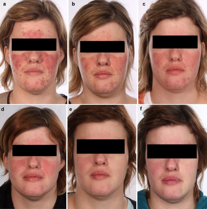 melanotan ii rosacea Medical Treatment Paramus, NJ Melanotan II (Tan Jabs): Why