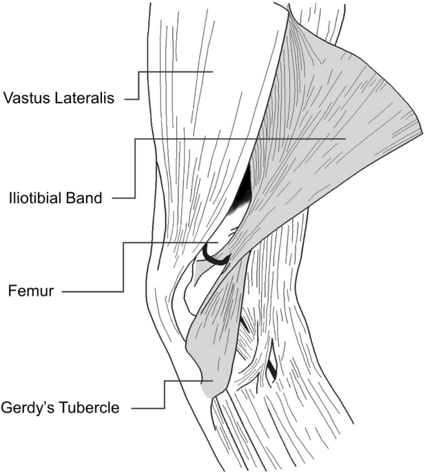 Iliotibial band (ITB) friction syndrome: A at full extension, the ITB
