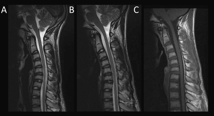 Cervical alterations in Hirayama disease: an MRI and FDG-PET combined  approach | SpringerLink