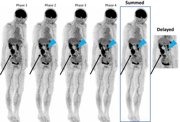 Dynamic whole-body FDG-PET imaging for oncology studies | Clinical and  Translational Imaging
