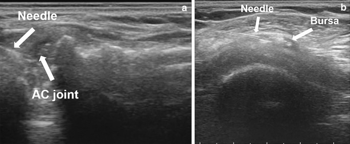 Acromioclavicular osteoarthritis and shoulder pain: a review of the role of  ultrasonography
