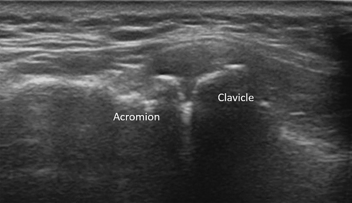 AC Joint, Acromioclavicular Joint