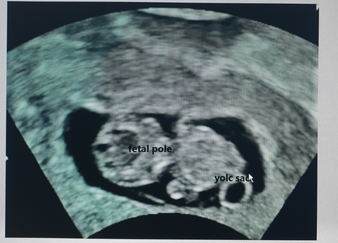 Fetal sex prediction measuring yolk sac size and yolk sac–fetal pole  distance in the first trimester via ultrasound screening | Journal of  Ultrasound