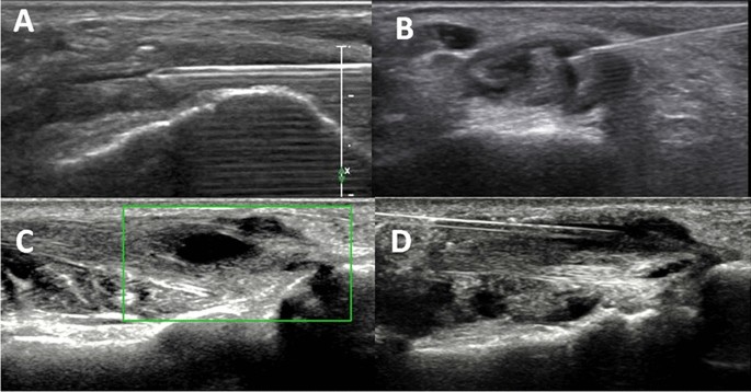 Ankle joint Cortisone injection  Musculoskeletal Ultrasound & Injections