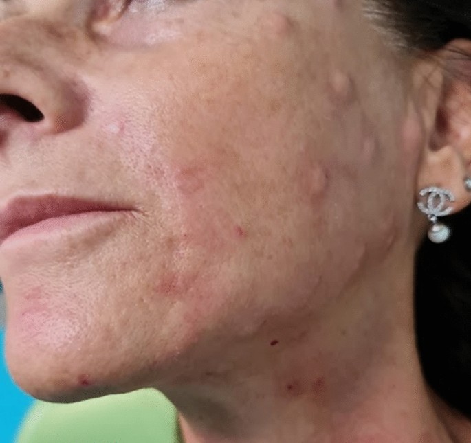 glutathione internal scars Top 8 Rich Foods For Glowing & Healthy Skin Amazon.com: VAITE Glutathione Whitening Pills