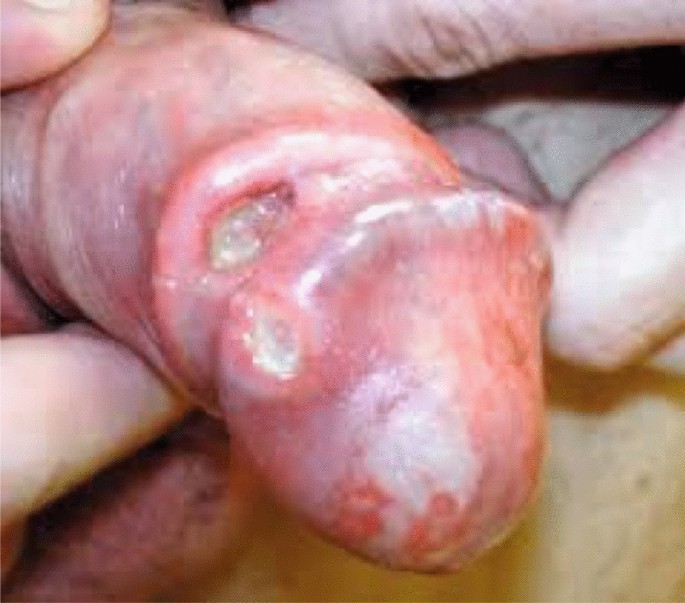 Recent Advances in the Management of Penile Cancer: A Contemporary Review  of the Literature | Oncology and Therapy