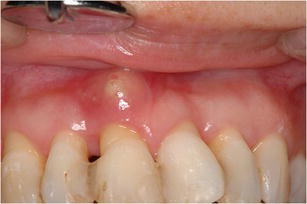 Periodontal Abscess: a Review and the Role of Antimicrobial Therapy |  Current Oral Health Reports