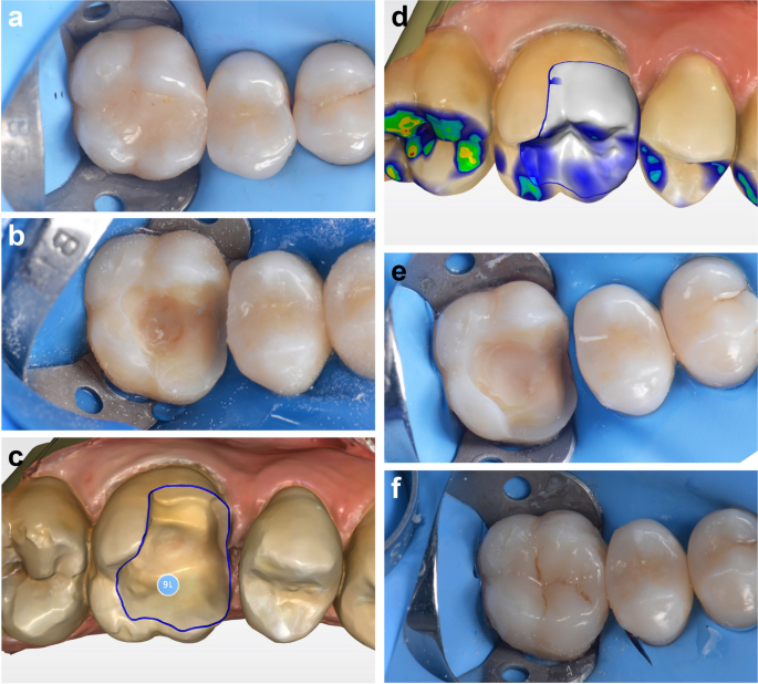 Cracked Tooth? Cosmetic Repair Options - Thanasas Family Dental