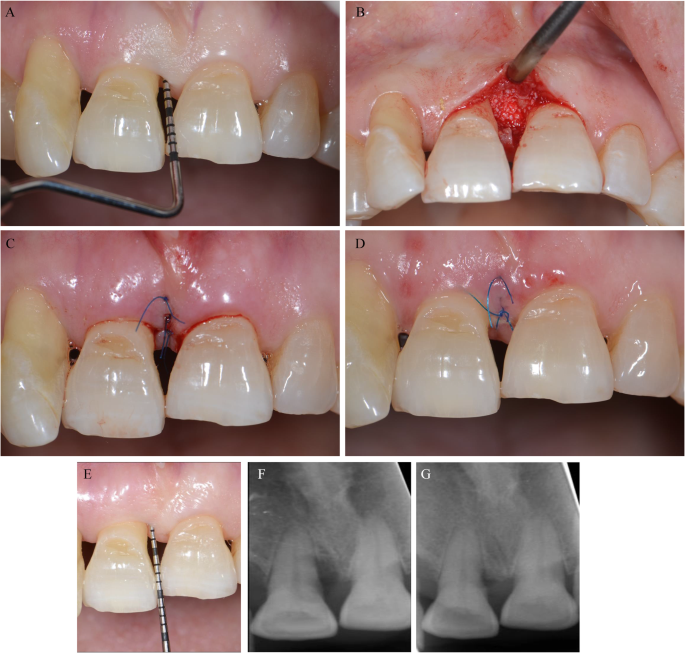 bpc-157 periodontal regeneration study Fundamental Concepts and New Perspectives for Periodontal Regeneration |  Current Oral Health Reports