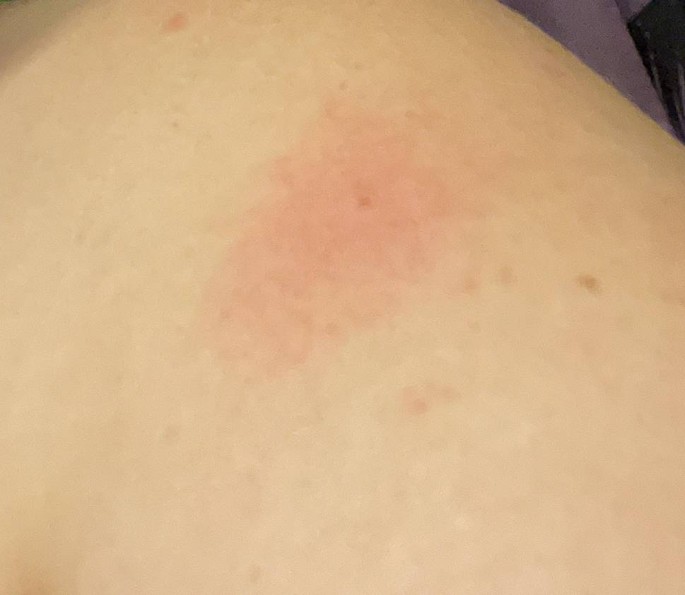 Localized eczematous rash affecting left and right regions of breast and  shoulder after Ad26.COV2.S vaccine against COVID-19 in a 30-year-old woman  with comorbidities