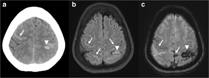 Reversible Cerebral Vasoconstriction Syndrome