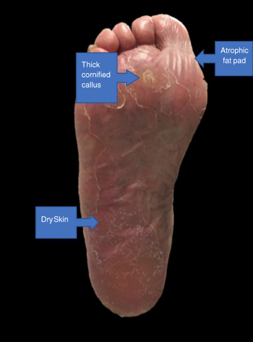 85% of Diabetic Amputations Start as Foot Ulcers