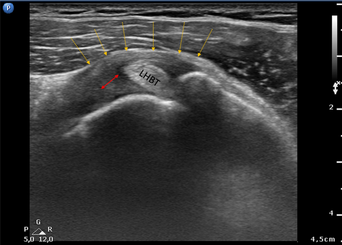 Typical magnetic resonance imaging scan showing the coracohumeral