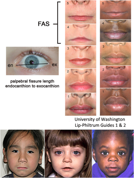 fetal cigarette syndrome Intrauterine Drug Exposure—What the Pediatrician Needs to Know. Part 1:  General Overview, Transplacental Drug Transfer, Teratogenicity, and Fetal  Alcohol Spectrum Disorder | Current Treatment Options in Pediatrics